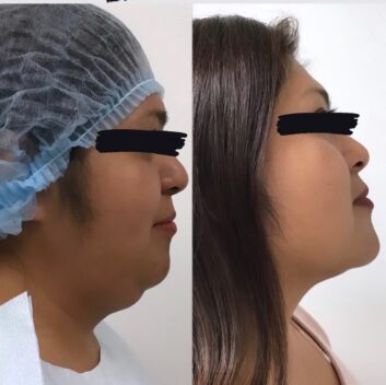 HD LIPOX™ of Jawline Specialist in Schaumburg, IL HD LIPOX™ of Jawline Specialist in Schaumburg, IL