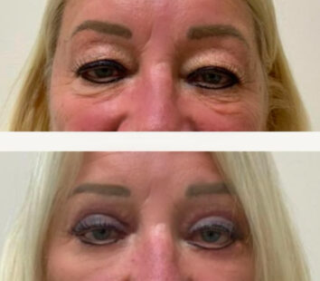 Eyelids Before & After Treatment Results at Face Works and Body Works Plastic Surgery