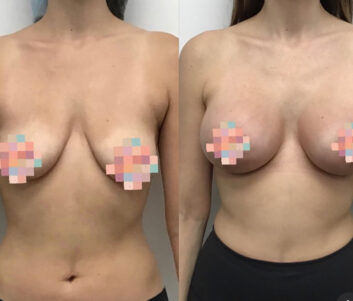 Breast Augmentation - Lift Before & After Results at Face Works and Body Work Plastic Surgery