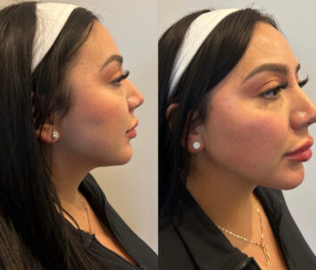 Dermal Fillers (Face, Lips, Chin, Jaw) Before & After Treatment Results at Face Works and Body Works Plastic Surgery