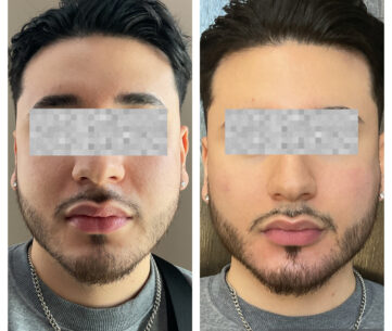 Dermal Fillers (Face, Lips, Chin, Jaw) Before & After Treatment Results at Face Works and Body Works Plastic Surgery